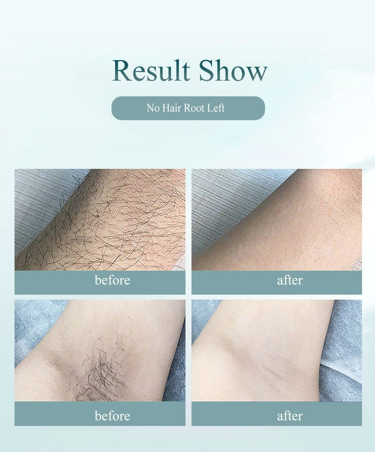 Professional Laser Hair Remover